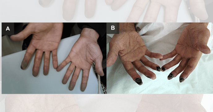 Relación entre tumores y el Fenómeno de Raynaud: Impacto de Inhibidores de Puntos de Control Inmunitarios