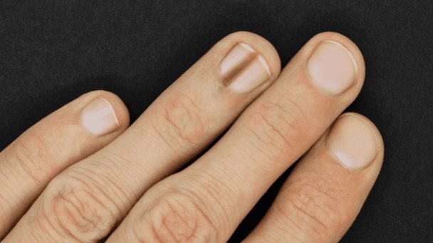 Melanoma lentiginoso acral, extraño caso de cáncer que se desarrolla bajo la uña Melanoma lentiginoso acral, extraño caso de cáncer que se desarrolla bajo la uña