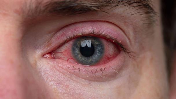 Conjuntivitis puede ser un síntoma temprano de Arcturus, nueva variante del COVID-19 Conjuntivitis puede ser un síntoma temprano de Arcturus, nueva variante del COVID-19