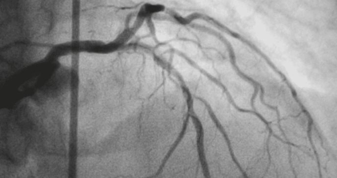 Infarto agudo de miocardio: ¿por qué los hispanos enfrentan un mayor riesgo de mortalidad?