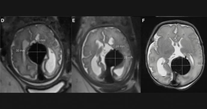 Equipo médico realiza con éxito la primera cirugía cerebral fetal en el útero materno