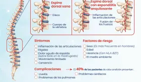 Espondilitis anquilosante - Infografía