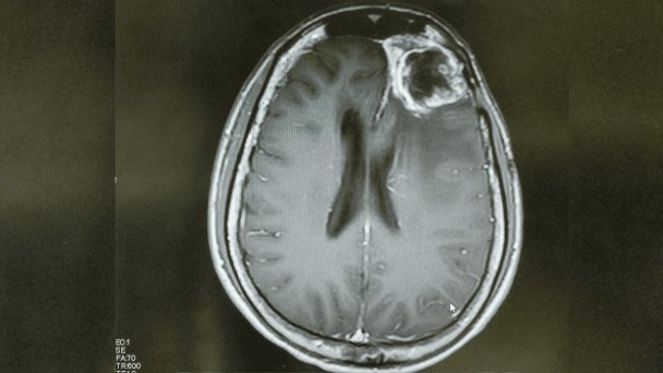 Nueva técnica logra cruzar la barrera hematoencefálica y llevar la quimioterapia al cerebro Nueva técnica logra cruzar la barrera hematoencefálica y llevar la quimioterapia al cerebro
