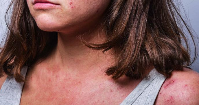 Estudio muestra la eficacia y seguridad de upadacitinib para tratar la dermatitis atópica en adolecentes