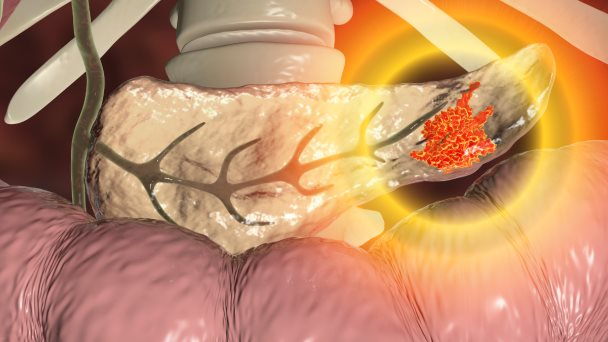 Cáncer de páncreas: vacuna de ARN personalizado retrasa recaída y enseña potencial terapéutico en ensayo Cáncer de páncreas: vacuna de ARN personalizado retrasa recaída y enseña potencial terapéutico en ensayo
