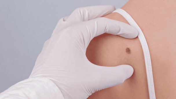 Organizaciones de salud lanzan campaña para educar sobre el impacto del melanoma en Puerto Rico Organizaciones de salud lanzan campaña para educar sobre el impacto del melanoma en Puerto Rico