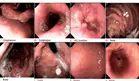 ¿Qué es la gastritis nerviosa y por qué es una respuesta del sistema digestivo al estrés y la ansiedad?
