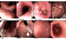 ¿Qué es la gastritis nerviosa y por qué es una respuesta del sistema digestivo al estrés y la ansiedad?