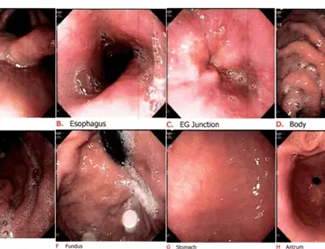 ¿Qué es la gastritis nerviosa y por qué es una respuesta del sistema digestivo al estrés y la ansiedad?