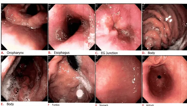 ¿Qué es la gastritis nerviosa y por qué es una respuesta del sistema digestivo al estrés y la ansiedad? ¿Qué es la gastritis nerviosa y por qué es una respuesta del sistema digestivo al estrés y la ansiedad?