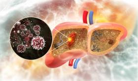 Desactivación del gen NSUN7 como un pronóstico negativo en el cáncer hepático