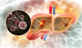 Desactivaci&oacute;n del gen NSUN7 como un pron&oacute;stico negativo en el c&aacute;ncer hep&aacute;tico