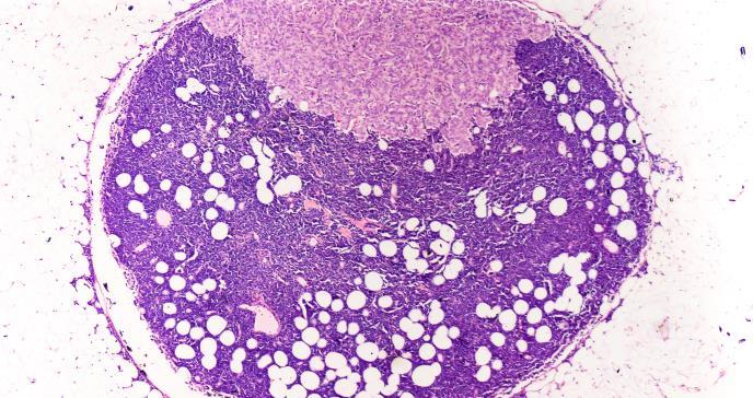 La propagación metastásica del cáncer de mama se acelera durante el sueño