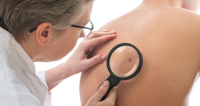 El melanoma no es el único cáncer de piel grave