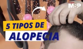 Cinco tipos de alopecia - #ExclusivoMSP