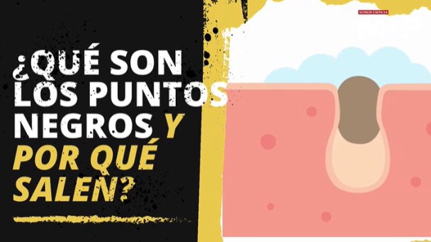 ¿Por qué nos salen puntos negros y qué son? - #ExclusivoMSP ¿Por qué nos salen puntos negros y qué son? - #ExclusivoMSP