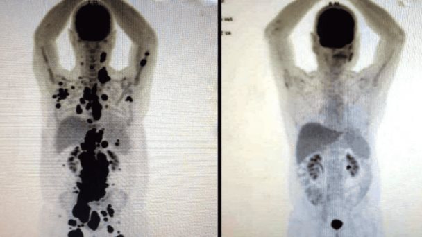 Terapia de células CAR-T logra en un mes la remisión total del linfoma en paciente brasileño Terapia de células CAR-T logra en un mes la remisión total del linfoma en paciente brasileño