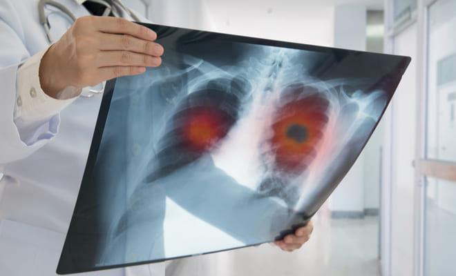 Paciente con hipotiroidismo y embolia pulmonar desarrolla trombofilia