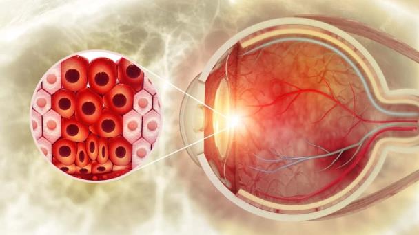 ¿Cómo identificar el cáncer de ojo? Síntomas similares a las infecciones que no deben ser ignorados