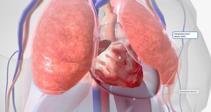 Investigadores logran revertir la insuficiencia cardíaca considerada irreversible en pacientes