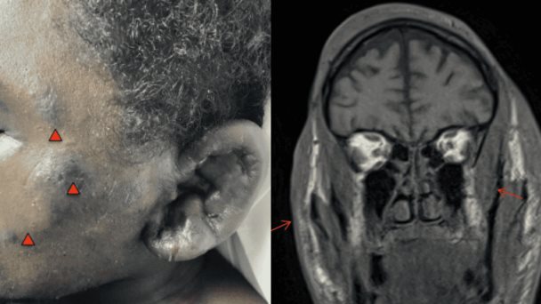 Linfedema periorbitario que desafiaba los esteroides encuentra respuesta en la quimioterapia