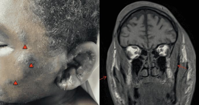 Linfedema periorbitario que desafiaba los esteroides encuentra respuesta en la quimioterapia