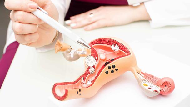 Todo sobre los miomas uterinos: el tratamiento que no afecta a la fertilidad de las mujeres