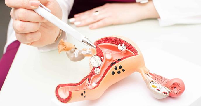 Todo sobre los miomas uterinos: el tratamiento que no afecta a la fertilidad de las mujeres