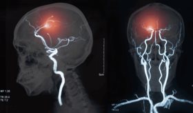 ApTOLL: Avance prometedor en el tratamiento del ictus que podría reducir la mortalidad y la discapacidad