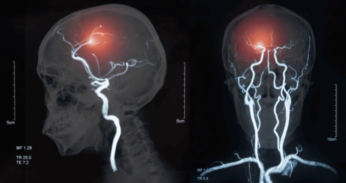 Sistema One Step Ictus permite reducir el tiempo de abordaje del ictus de 70 a 17 minutos