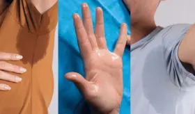 Hiperhidrosis: La condición médica detrás de la sudoración excesiva sin relación al calor o ejercicio