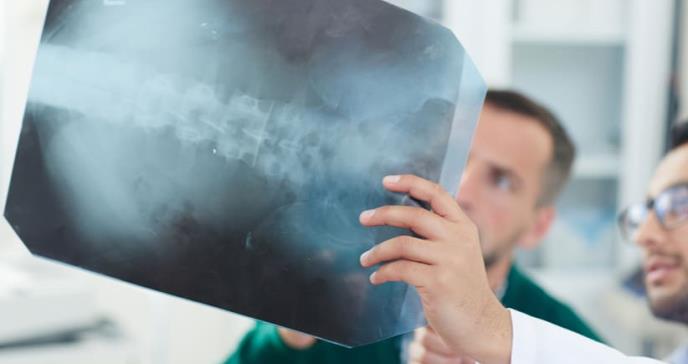 Tumor en la médula espinal: ¿Cómo esta condición impacta en las funciones motoras?