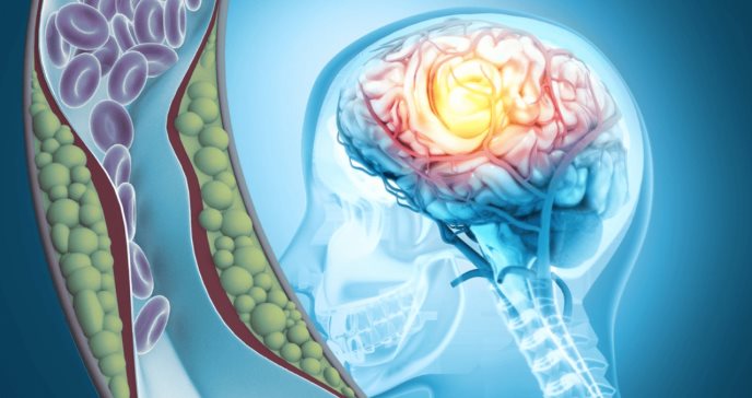 Estudio comprueba que la obesidad agrava los síntomas de las lesiones cerebrales traumáticas
