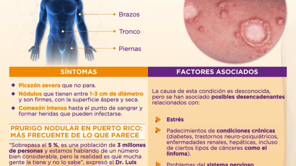 Prurigo nodular | Infografía Prurigo nodular | Infografía