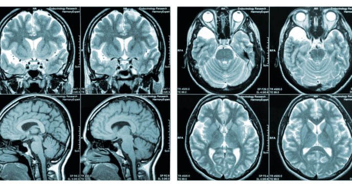 Identifican variante genética que puede ser clave en el tratamiento de la esclerosis múltiple