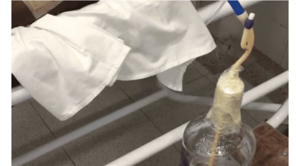 Utilizan aguardiente en un caso de drenaje torácico como medida de emergencia Utilizan aguardiente en un caso de drenaje torácico como medida de emergencia