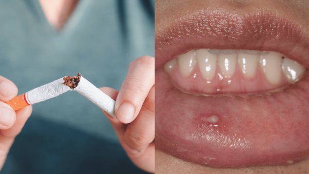 Interacción entre el humo del tabaco y el VPH predisponen a padecer cáncer de cabeza y cuello Interacción entre el humo del tabaco y el VPH predisponen a padecer cáncer de cabeza y cuello