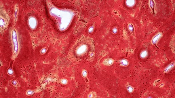 Intoxicación por vitamina D e hipercalcemia severa en paciente por mal uso de suplementos nutricionales