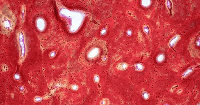 Intoxicación por vitamina D e hipercalcemia severa en paciente por mal uso de suplementos nutricionales