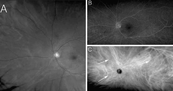 Mujer pierde gradualmente la visión en ojo izquierdo por atípica coriorretinopatía en perdigonada