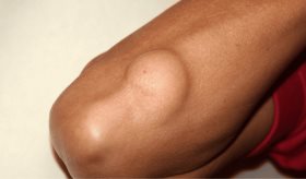 Liposarcoma: cáncer poco común de células grasas que provoca dolor abdominal y bultos debajo de la piel