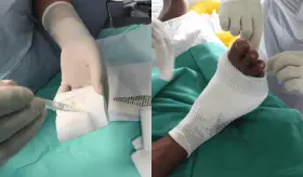 Implementan terapia larval, antigüa técnica de curación con larvas, para heridas de díficil cicatrización