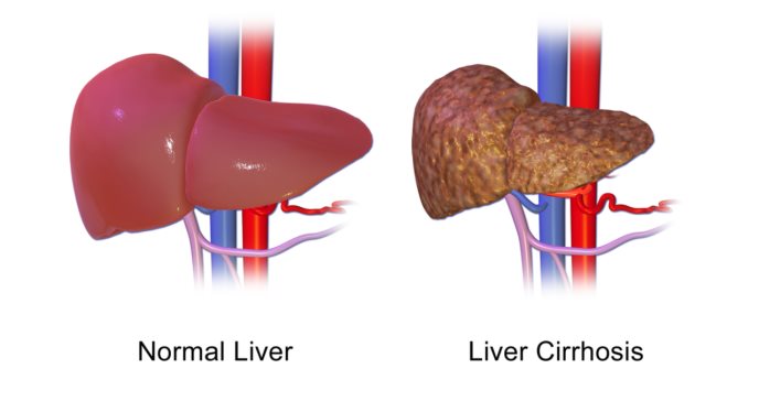 Estudio clínico ofrece oportunidad de tratamiento innovador a pacientes con cirrosis descompensada