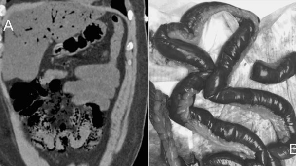 Isquemia intestinal inducida por cocaína: una complicación grave de su consumo Isquemia intestinal inducida por cocaína: una complicación grave de su consumo