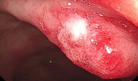 Paciente desarrolla úlceras rectales por uso inadecuado de inodoro bidé