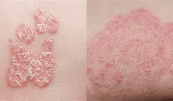&iquest;Eczema o micosis? La diferencia entre ambas condiciones que afectan la piel