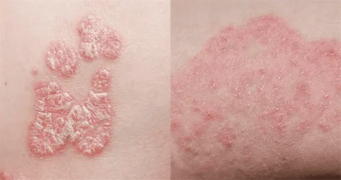 ¿Eczema o micosis? La diferencia entre ambas condiciones que afectan la piel ¿Eczema o micosis? La diferencia entre ambas condiciones que afectan la piel