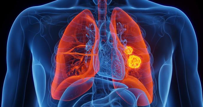 Robot quirúrgico para tratar el cáncer de pulmón: ¿Cómo funciona esta técnica?