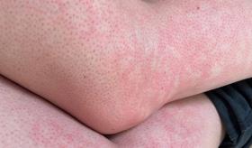 Corticoides en el cuerpo: adelgazamiento de la epidermis como consecuencia del tratamiento prolongado