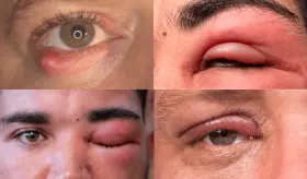 La celulitis que afecta el ojo: &iquest;Qu&eacute; es y por qu&eacute; se origina?